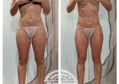 Prima e Dopo BootyUp di Laura Cavarischia - Metodo per il modellamento corpo - Centro La Creazione Tolentino - Modellamento Corpo